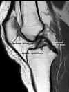 Ligaments croiss