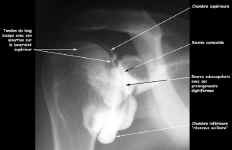 Arthrographie de face. RX