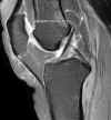 Ligament crois antrieur