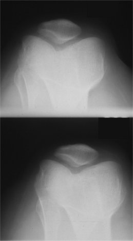 RX - Incidence fmoro-patellaire