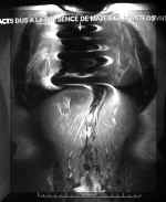 Artfacts dus  du matriel d'ostosynthse