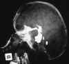 La Ventriculographie