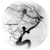 Pathologies vasculaires crbrales