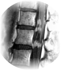 Pathologies rachidiennes