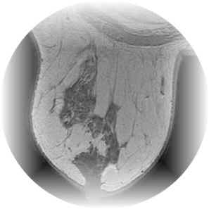 Pathologies  du sein