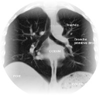 Pathologies  Thoraciques