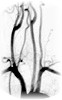 Vaisseaux du cou (Troncs supra-aortiques)