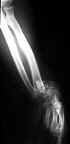 Fracture-Luxation du poignet