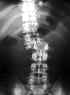 Fracture de Lombaire. 
