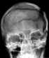 Fracture du crne