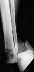 Luxation-fracture de la Cheville. 