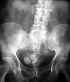 Prsence de "corps trangers" dans le rectum