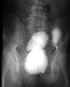 Ingestion de pltre