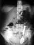 Petite cuillre ingre avec occlusion intestinale