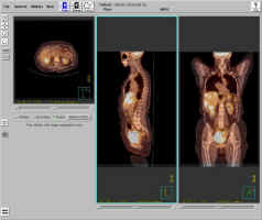 Cancer du colon - Mtastases