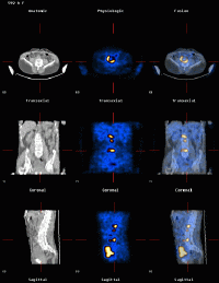 Lymphome malin