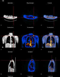 Mtastases d'un cancer du col utrin