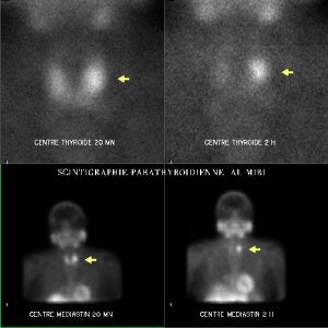 Scintigraphie des glandes parathyrodes au MIBI