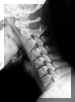 cervicalep.jpg (10962 octets)