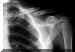 fracturclavicul.jpg (11429 octets)