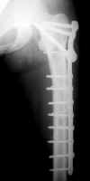 osteosynthfemur.jpg (6899 octets)