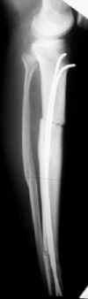 osteosynthtibia.jpg (6875 octets)