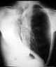 pneumonectomie2w.jpg (21019 octets)