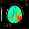 Stroke WorkUp