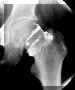 arthrohanch.jpg (9042 octets)
